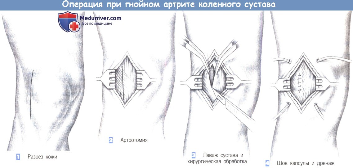 Техника операции при гнойном артрите коленного сустава
