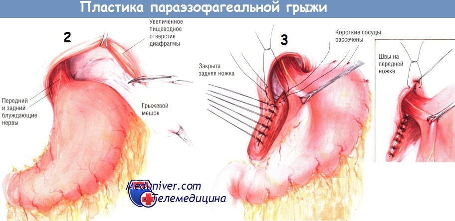 Параэзофагеальная грыжа пищеводного отверстия диафрагмы лечение thumbnail