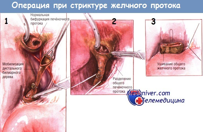 Ход операции резекции стриктуры желчного протока и гепатикоеюностомии