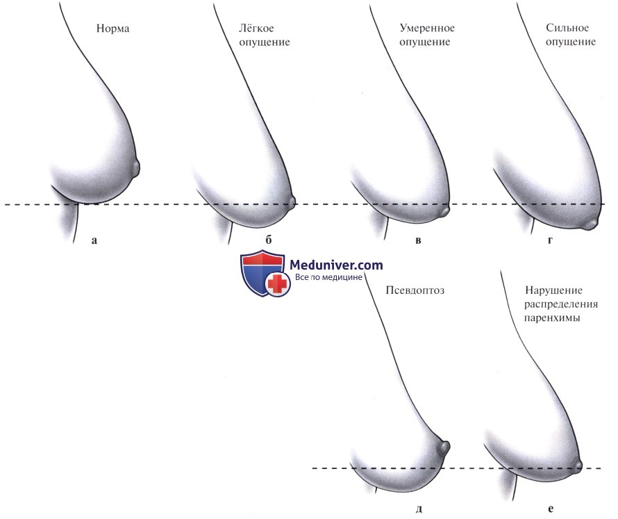 Классификация опущения молочной железы (птоза)