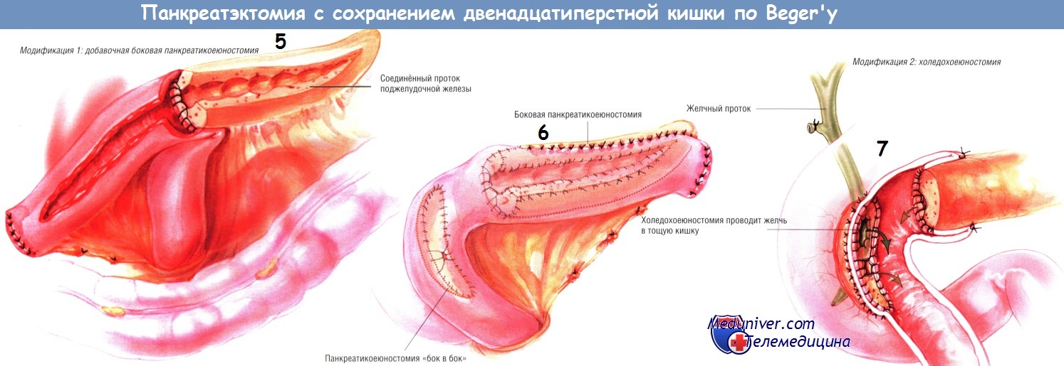 Методика операции панкреатэктомии с сохранением двенадцатиперстной кишки