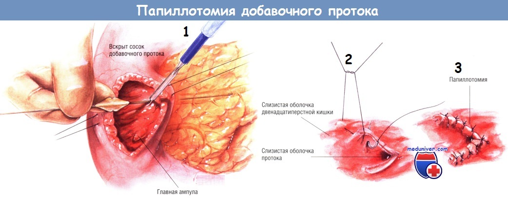Методика папиллотомии добавочного протока при расщепленной поджелудочной железе
