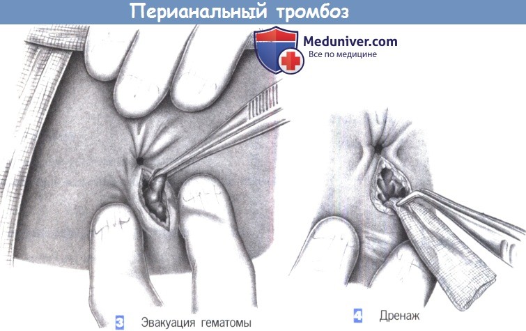 Этапы и техника операции при перианальном тромбозе