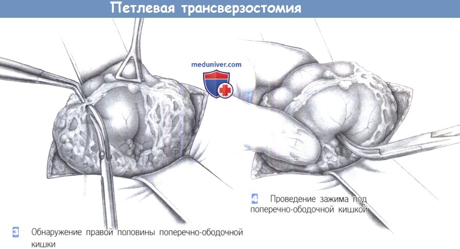 Этапы и техника петлевой трансверзостомии (двуствольной колостомии)