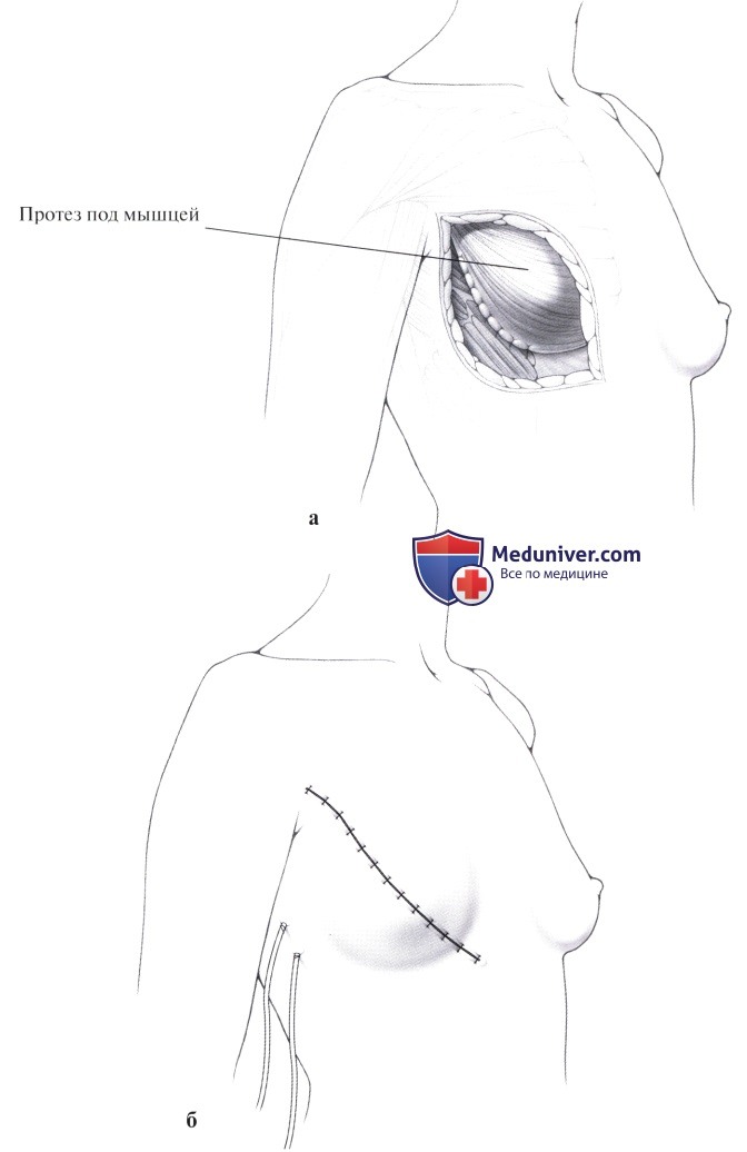 Имплантация (установка) постоянного протеза молочной железы