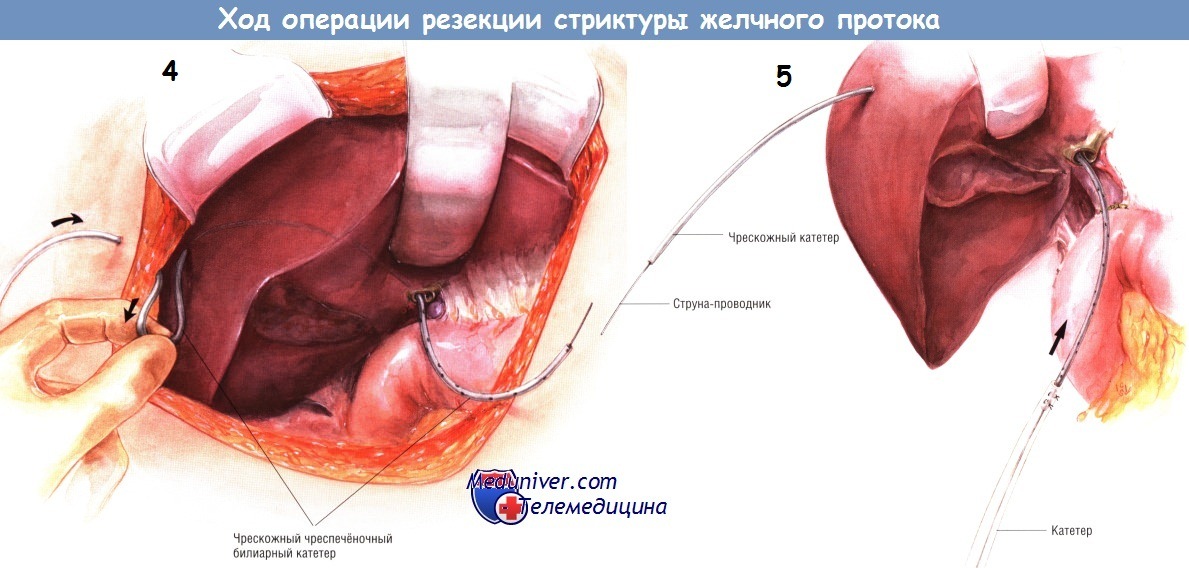 Ход операции резекции стриктуры желчного протока и гепатикоеюностомии