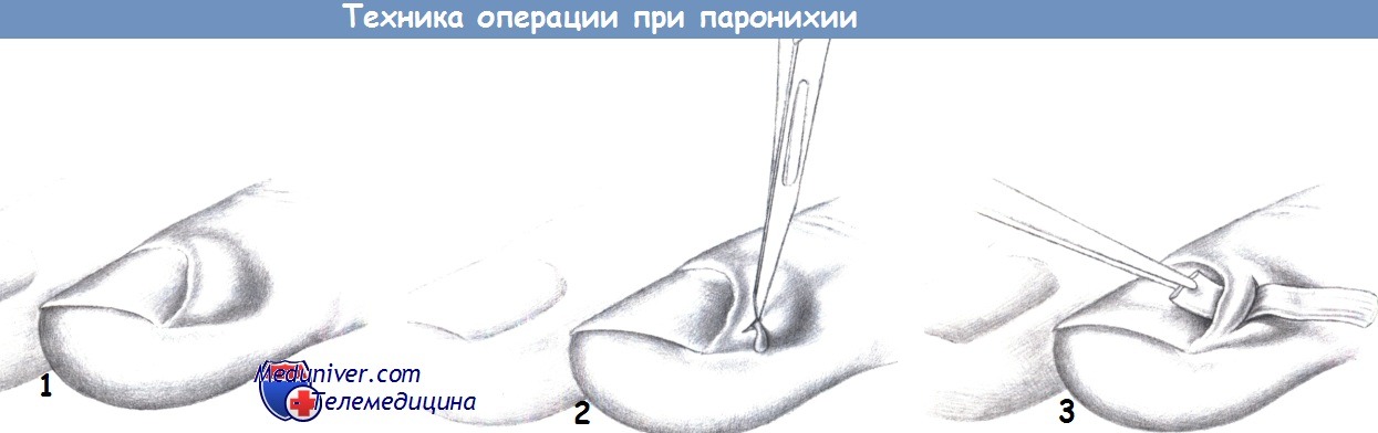 Этапы и техника операции при нагноении ногтевого валика - паронихии
