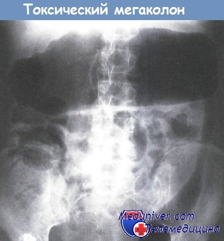 Рентгенограмма при токсическом мегаколоне