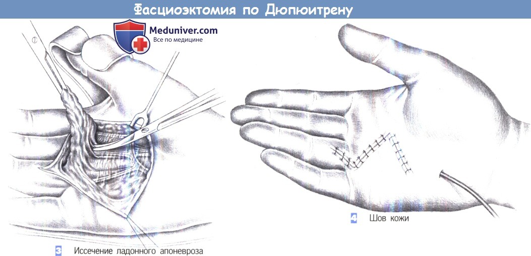 Удаление ладонного апоневроза по Дюпюитрену (фасциоэктомия)