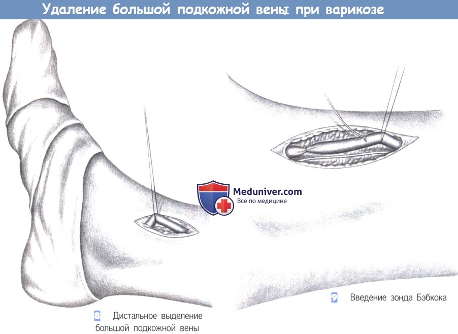 Техника удаления большой подкожной вены при варикозе ног