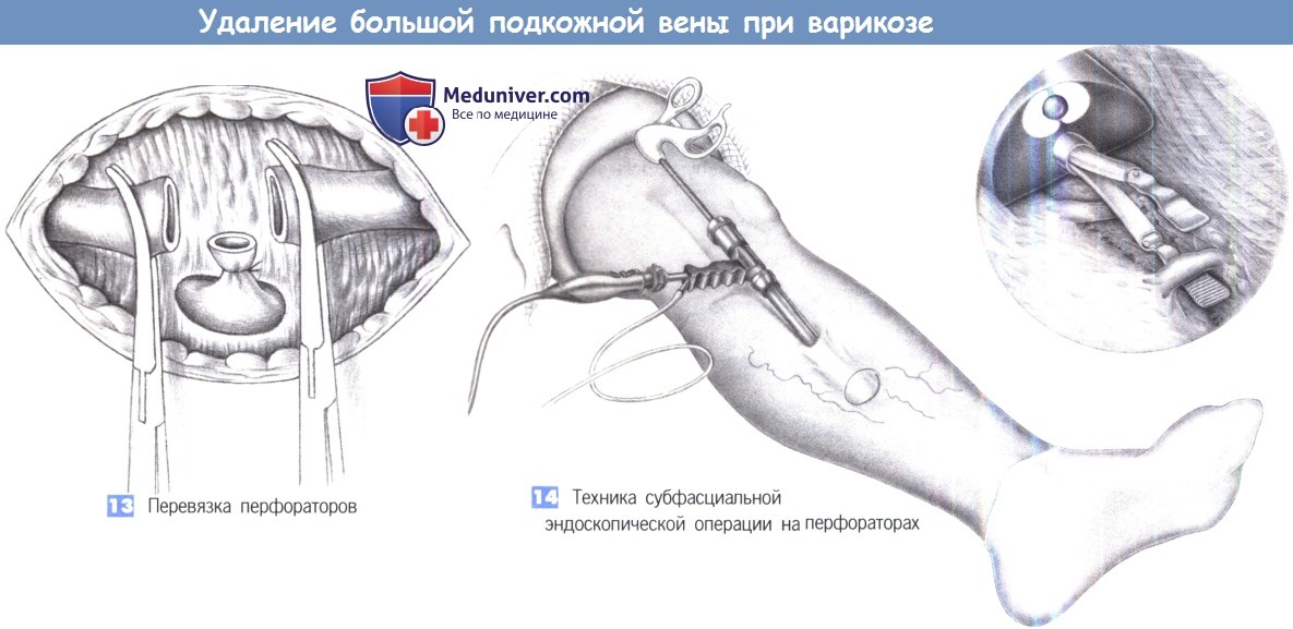 Техника удаления большой подкожной вены при варикозе ног