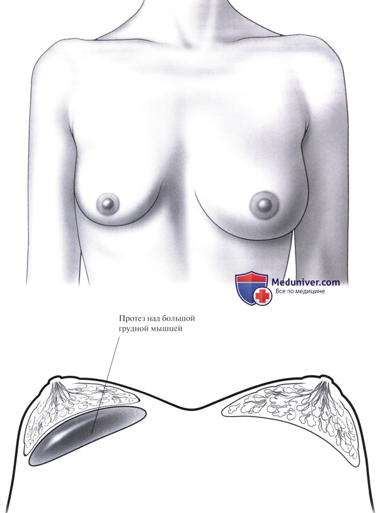 Увеличивающая маммопластика (операция увеличения молочных желез)