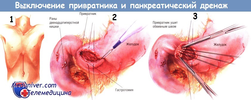 Методика выключения привратника, панкреатического дренажа при травме