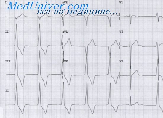 Синдром преждевременного возбуждения желудочков сердца thumbnail