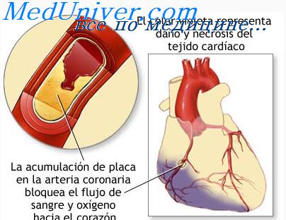 Неосложненный инфаркт миокарда принципы лечения thumbnail