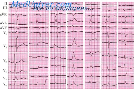 Постинфарктный кардиосклероз на экг фото с описанием