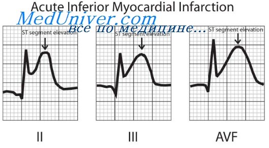 инфаркт миокарда при пороке сердца