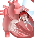 пороки сердца в кардиологии