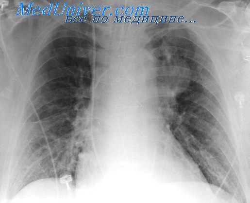 Пневмония у детей с пороком сердца thumbnail