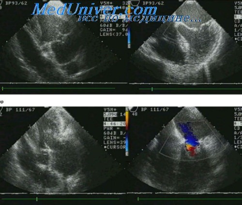 Эхокардиография при инфарктах миокарда thumbnail