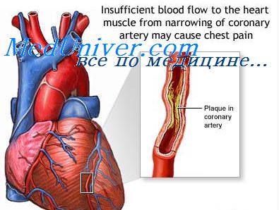 осложнения инфаркта миокарда