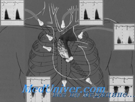 эхокардиография при аортальном стенозе
