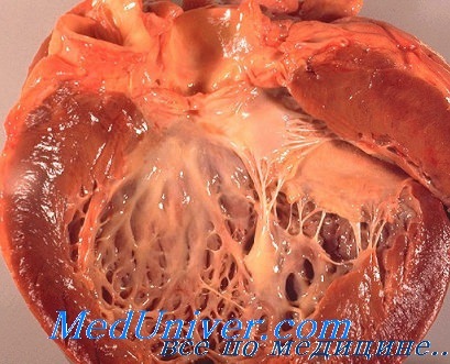 Методы хирургического лечения сердечной недостаточности thumbnail