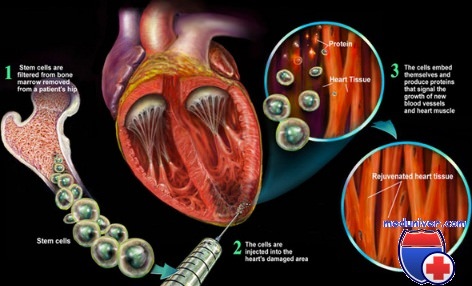 стволовые клетки при сердечной недостаточности