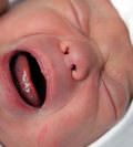 кардиопатии у новорожденных