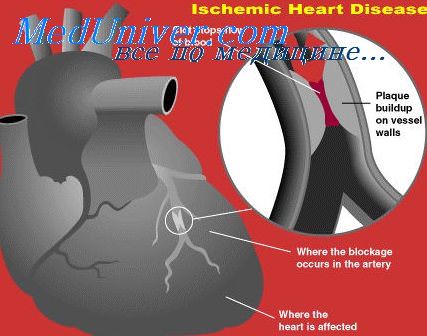 Морфологический субстрат при инфаркте миокарда thumbnail