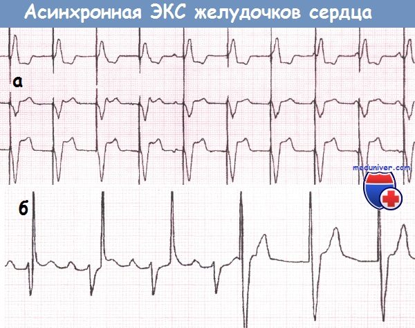 Асинхронная электрокардиостимуляция (ЭКС) желудочков сердца