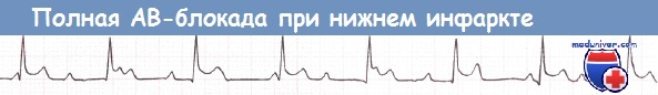 Полная АВ-блокада при нижнем инфаркте миокарда на ЭКГ