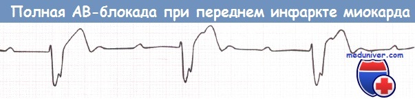Полная АВ-блокада при переднем инфаркте миокарда на ЭКГ
