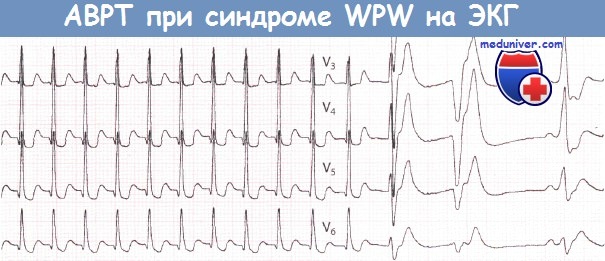 АВРТ при синдроме WPW (Вольфа-Паркинсона-Уайта) на ЭКГ