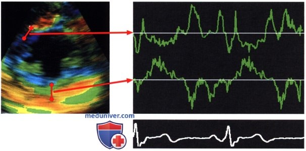 Деформация и скорость деформации миокарда левого желудочка
