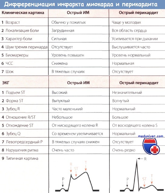 Дифференциальная диагностика инфаркта миокарда и перикардита