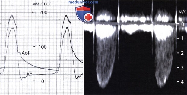 Допплер-ЭхоКГ функции протеза клапана сердца