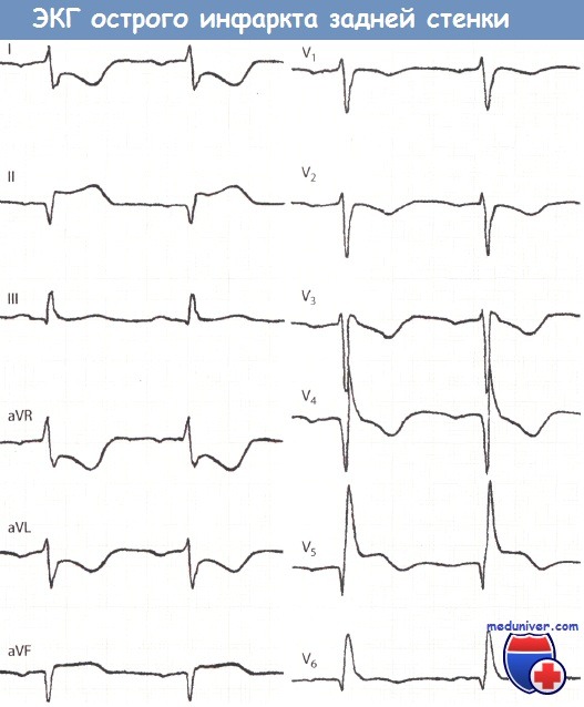 ЭКГ при остром инфаркте миокарда задней стенки