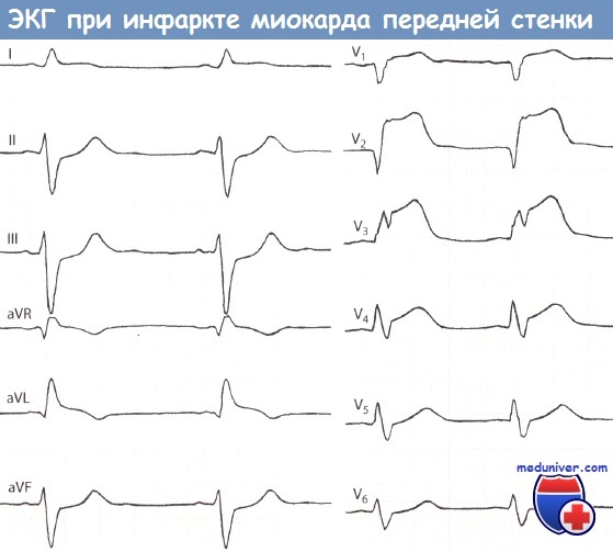 Инфаркт миокарда передней стенки левого желудочка экг thumbnail