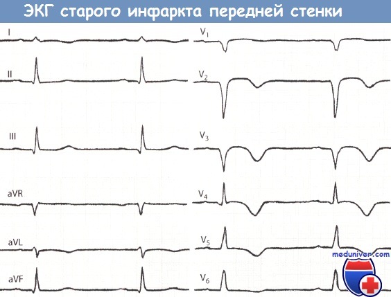 Инфаркт миокарда отведения v2 v4 thumbnail