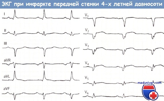 Пример ЭКГ старого инфаркте миокарда передней стенки левого желудочка
