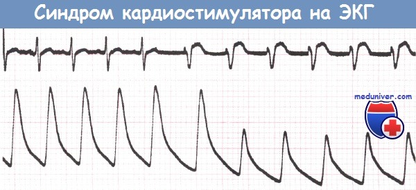ЭКГ при синдроме кардиостимулятора
