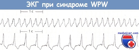 ЭКГ при синдроме Вольфа-Паркинсона-Уайта (WPW)