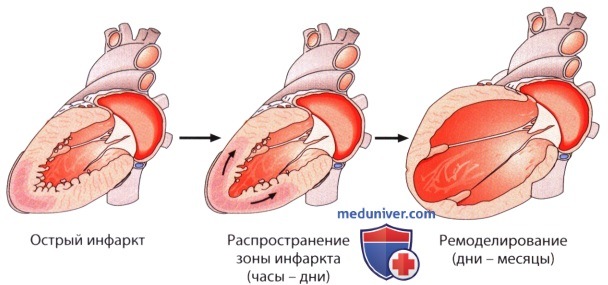ЭхоКГ левого желудочка при инфаркте миокарда