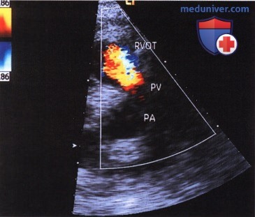 ЭхоКГ пульмонального клапана (клапана легочной артерии)