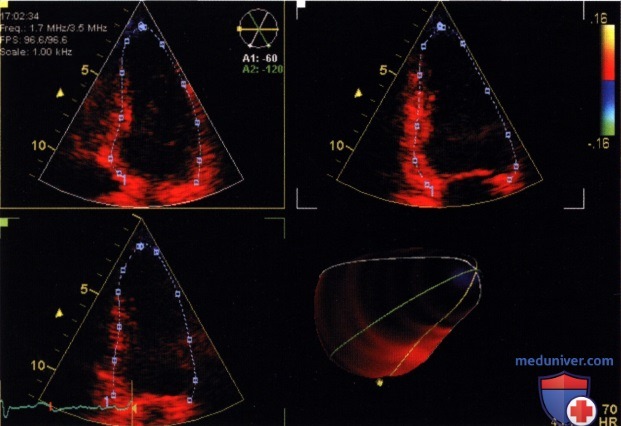 Оценка функции миокарда при нарушении проведения возбуждения по тканевой допплер-эхокардиографии