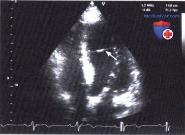 ЭхоКГ осложнений дилатационной кардиомиопатии (ДКМП)