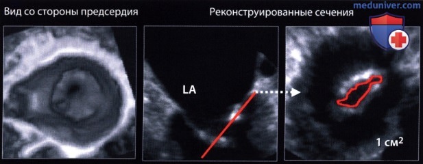 Трехмерная эхокардиография при митральном и аортальном стенозе