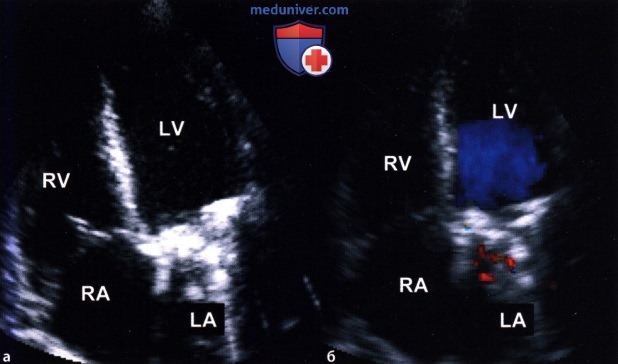 ЭхоКГ оценка протезированного клапана сердца