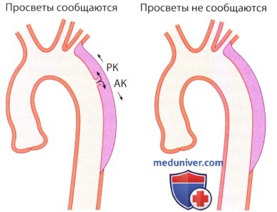 ЭхоКГ при расслоении стенки аорты (аневризме аорты)